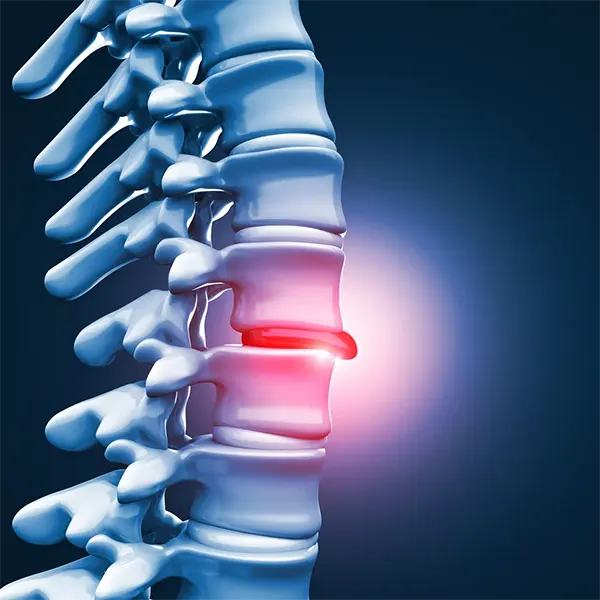 Disc Injury Treatment Near Me in Allison Park, PA. Chiropractor For Disc Injury Pain Relief.